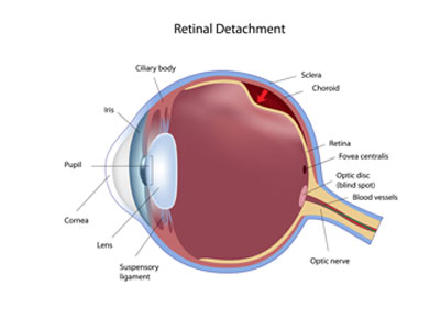 Retinal tears and Detachment