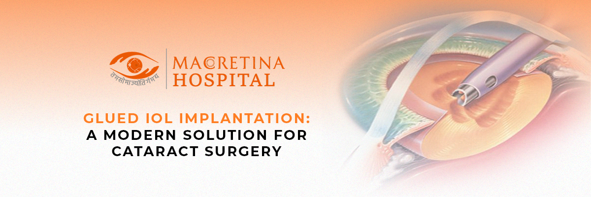 Glued IOL Implantation: A Modern Solution for Cataract Surgery